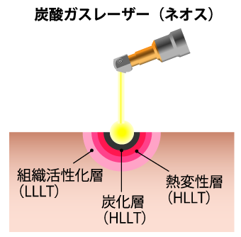 炭酸ガスレーザー(ネオス)