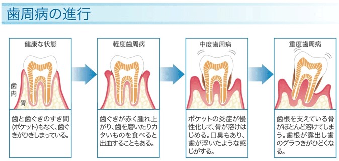 歯周病の進行