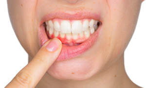 歯周炎と歯槽膿漏の違い
